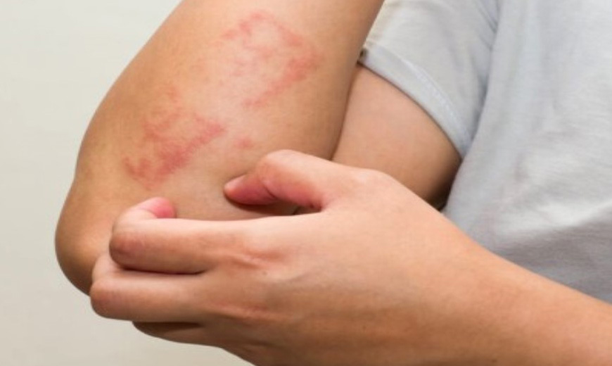 Allergic Rhinitis & Urticaria (Hives)