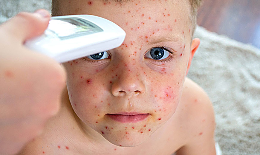 Cold Sores, Chickenpox, Shingles